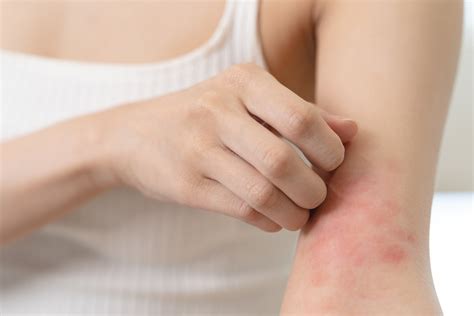 5 Essential Oils For Skin Rashes Soothe Heal And Prevent Anti Fungal Blends To Stop Itching