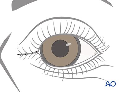 Lateral tarsorrhaphy for Irreversible paralysis, eye complex