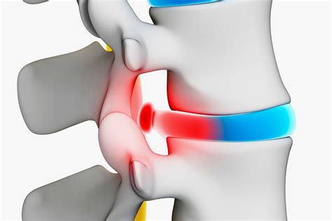 H Rnia De Disco O Que Causas Sintomas E Tratamentos Hernia Discal