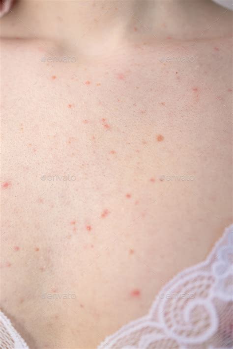 Teenage Girl Have A Lot Of Red Spots On Her Chest From Acne Hormones