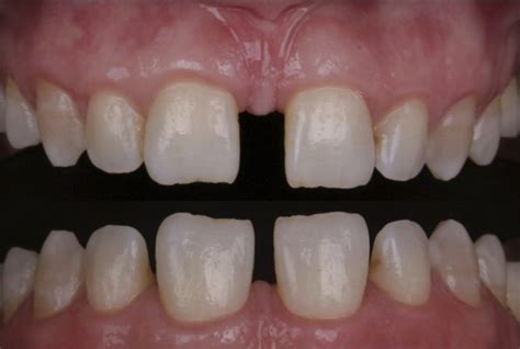 A Combined Approach For Diastema Closure Styleitaliano Org