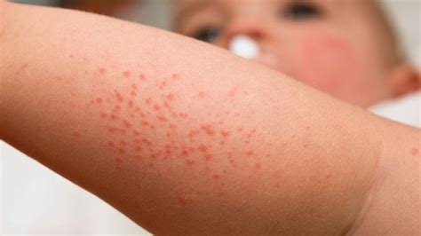 Cuidados De La Dermatitis Atópica Eczema Alergia En República