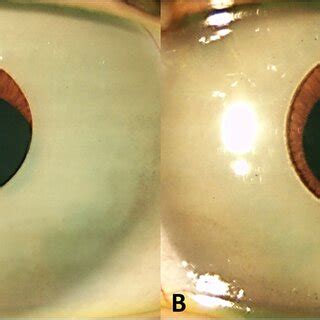 Cosmetic iris implants located in the anterior chamber with iris ...