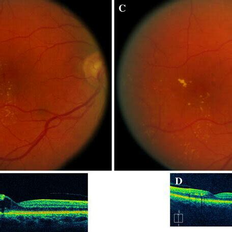 Fundus Photo Of Csme Csme Clinically Significant Macular Edema