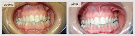 Dental Implants Veneers And Crowns Gallery Bounty Road Dental