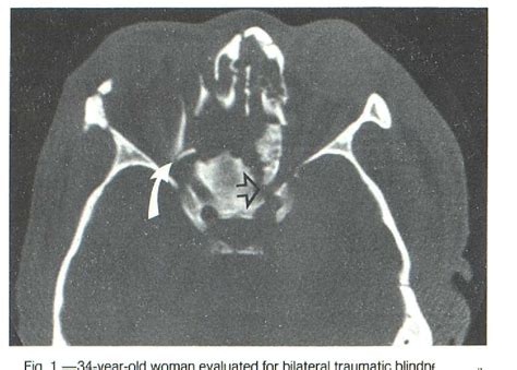 Figure 1 from CT demonstration of optic canal fractures. | Semantic Scholar