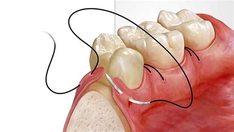 What Is Alveoloplasty And Who Needs It