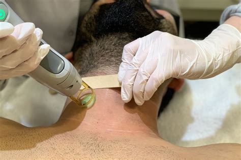 Laser Ontharen Voor Mannen Met Gentlemax Pro In Rotterdam