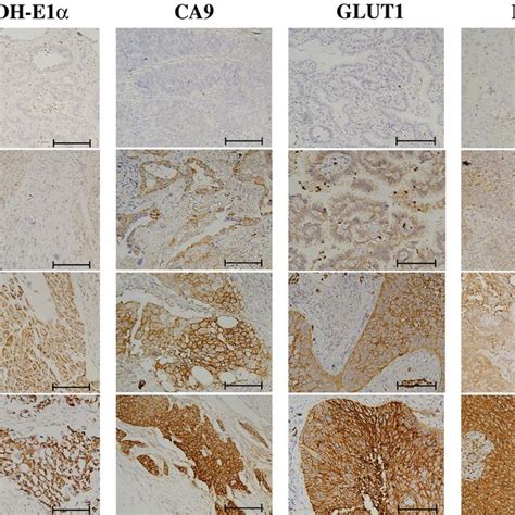 Immunostaining of PDH E1α CA9 GLUT1 and PKM2 The immunoreactivity