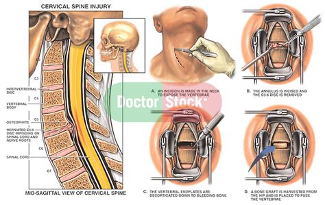 C5 6 Cervical Spine Injury With Surgical Anterior Cervical Discectomy