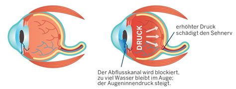 Grüner Star Glaukom Kantonsspital Winterthur KSW