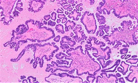 Pathology Outlines Serous Borderline Tumor