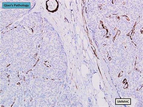 Qiaos Pathology Solid Papillary Carcinoma Of The Breast A Photo On Flickriver