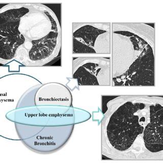 pulmonary features  alpha  antitrypsin deficiency aatd  shown