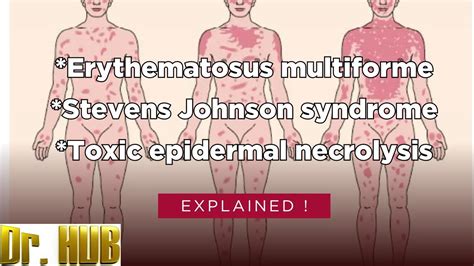 Erythematosus Multiforme Vs Stevens Johnson Syndrome Vs Toxic Epidermal