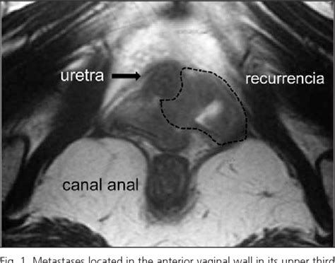 Figure 1 From Vaginal Metastasis Of Colon Cancer Semantic Scholar