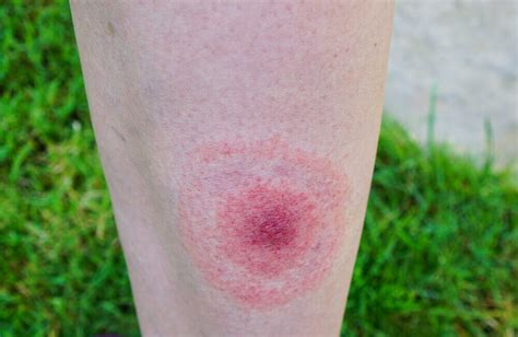 Lyme Disease Symptoms You Need To Know Step To Health