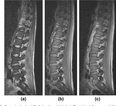 Figure 8 From The Mri Appearances Of Early Vertebral Osteomyelitis And