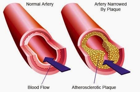 Aterosclerose Defini O Causas Sintomas Diagn Stico Tratamento E