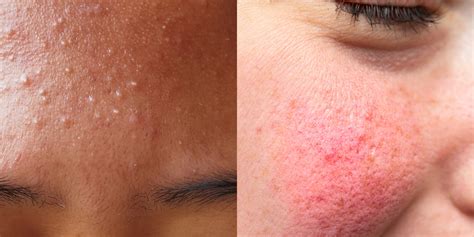 Acne Vs Rosacea What’s The Difference Curology