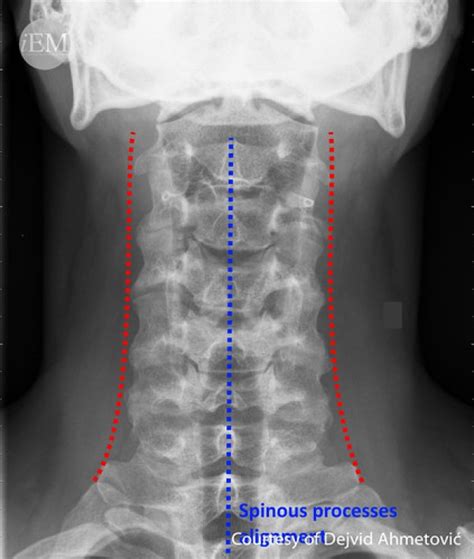 How to Read C-Spine X-Ray – International Emergency Medicine Education ...