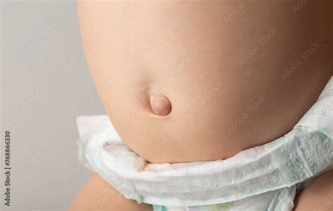 Umbilical Hernia In Newborns On The Stomach Close Up Treatment Of