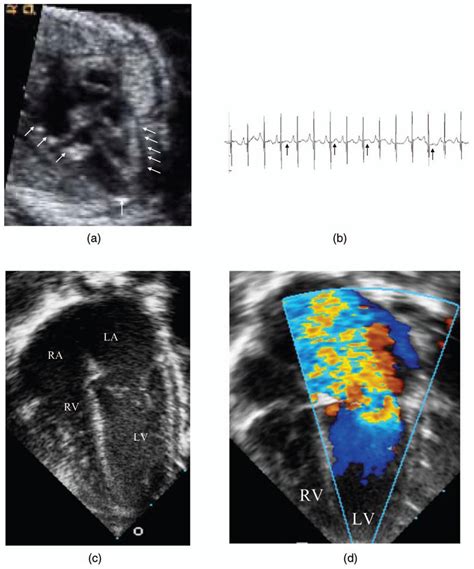 Case 1 Echocardiograms A Four Chamber View Of The Fetal Heart At 26