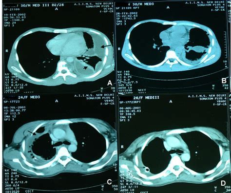 A Ct Chest Of Patient With Loculated Empyema Thoracis Arrow And B