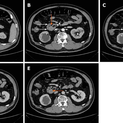 Incomplete Annular Pancreas A Orange Arrow Shows Narrowed Duodenum Download Scientific