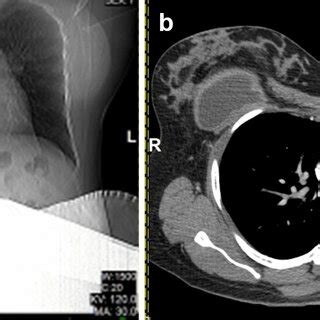 23 Year Old Pregnant Woman At 36 Week Gestation With History Of