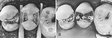 16 Complex Amalgam Restorations Pocket Dentistry