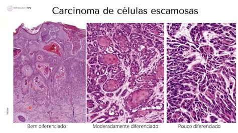 Carcinoma De Células Escamosas Youtube