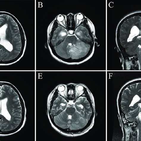 Preoperative And Postoperative Mri Comparison Axial T2 Weighted Images Download Scientific