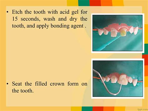 Asthetic Crowns In Pediatric Dentistry Ppt