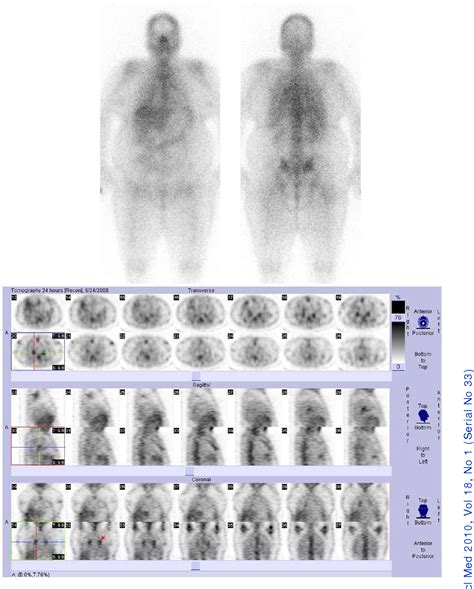 SENSITIVITY OF GALLIUM SCINTIGRAPHY FOR EVALUATION OF RECURRENT