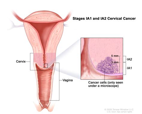 Cervical Cancer Cells Vs Normal Cells