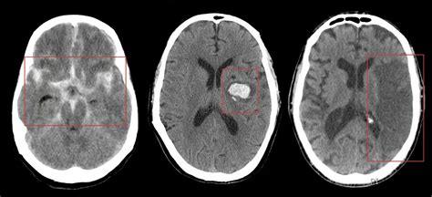 Avc Hemorr Gico Na Tomografia Poss Vel Diagnosticar