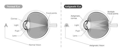 Eye Astigmatism - Symptoms & Treatment Options | Binetter Eye Centre