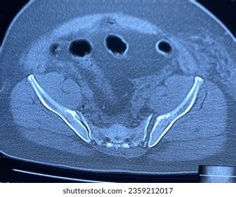 Hundred Ct Scan Pelvis Royalty Free Images Stock Photos Pictures