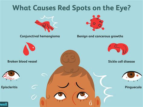 What Causes Red Flashing Lights In Eyes Americanwarmoms Org