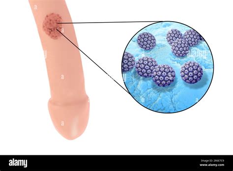 Penile Genital Warts And Close Up View Of Human Papilloma Virus