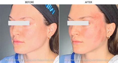 Best Non Surgical Facelift Options To Try In