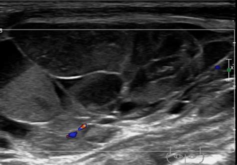 Ultrasound Findings Of Cervical Lymphangioma With Amain四川亚麦科技 Leader