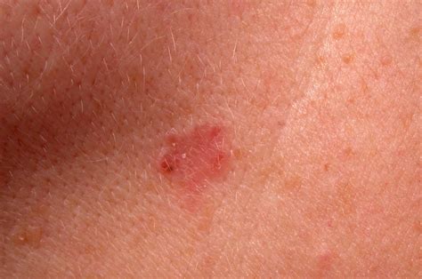 Skin Cancer On Face Early Signs