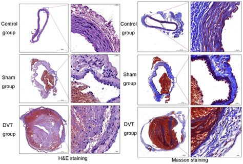 Venous Thrombosis Histology