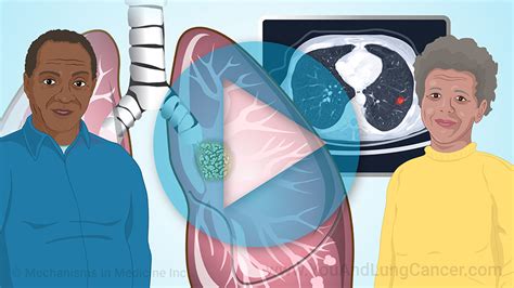 Animation - Understanding Non-Small Cell Lung Cancer