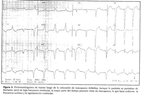 Tratamiento Del S Ndrome De Qt Largo Adquirido Con Estimulaci N