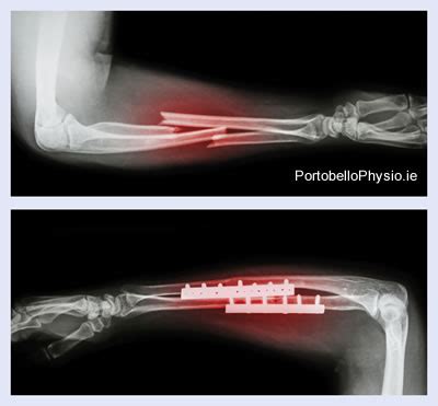 Broken Wrist - Portobello Physiotherapy