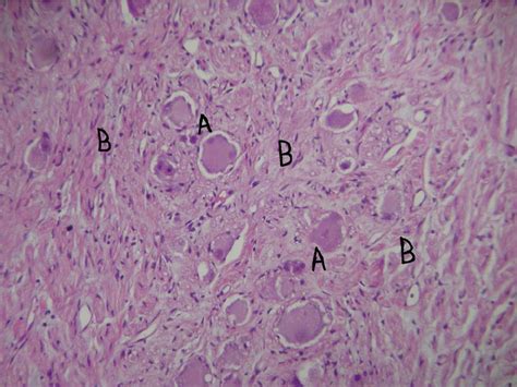 Irregular Distribution Of Histologically Mature Ganglion Cells A In A