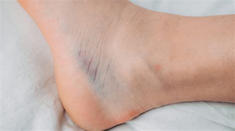 Swollen Ankle Sprain Osteoarthritis Heat What To Do